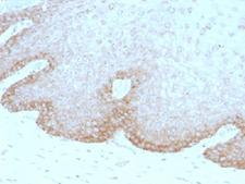 MEGF1 / FAT2 Antibody - IHC testing of human cervical carcinoma with FAT2 antibody (clone 8C5). Required HIER: boil tissue sections in 10mM citrate buffer, pH 6, for 10-20 min followed by cooling at RT for 20 min.