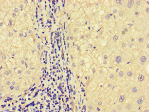 MEGF10 Antibody - Immunohistochemistry of paraffin-embedded human liver cancer at dilution of 1:100
