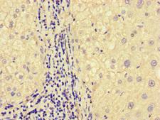 MEGF10 Antibody - Immunohistochemistry of paraffin-embedded human liver cancer at dilution of 1:100