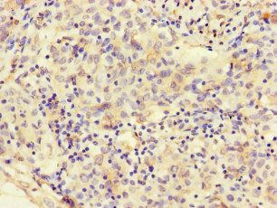 MEGF10 Antibody - Immunohistochemistry of paraffin-embedded human lung cancer at dilution of 1:100