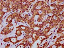 MEGF8 Antibody - Immunohistochemistry Dilution at 1:200 and staining in paraffin-embedded human liver cancer performed on a Leica BondTM system. After dewaxing and hydration, antigen retrieval was mediated by high pressure in a citrate buffer (pH 6.0). Section was blocked with 10% normal Goat serum 30min at RT. Then primary antibody (1% BSA) was incubated at 4°C overnight. The primary is detected by a biotinylated Secondary antibody and visualized using an HRP conjugated SP system.
