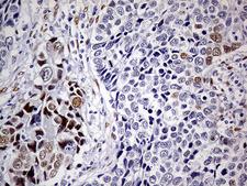MEIS1 Antibody - Immunohistochemical staining of paraffin-embedded Carcinoma of Human lung tissue using anti-MEIS1 mouse monoclonal antibody. (Heat-induced epitope retrieval by 1mM EDTA in 10mM Tris buffer. (pH8.5) at 120°C for 3 min. (1:500)