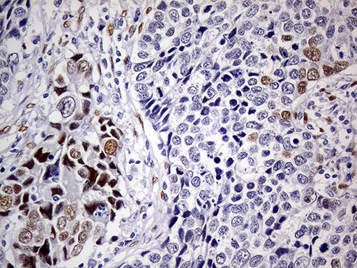 MEIS1 Antibody - Immunohistochemical staining of paraffin-embedded Carcinoma of Human lung tissue using anti-MEIS1 mouse monoclonal antibody. (Heat-induced epitope retrieval by 1mM EDTA in 10mM Tris buffer. (pH8.5) at 120°C for 3 min. (1:500)