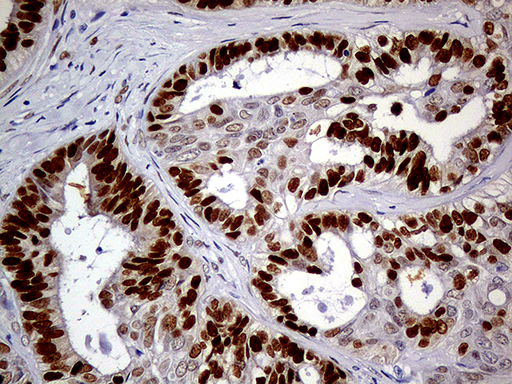 MEIS1 Antibody - Immunohistochemical staining of paraffin-embedded Adenocarcinoma of Human ovary tissue using anti-MEIS1 mouse monoclonal antibody. (Heat-induced epitope retrieval by 1mM EDTA in 10mM Tris buffer. (pH8.5) at 120°C for 3 min. (1:500)
