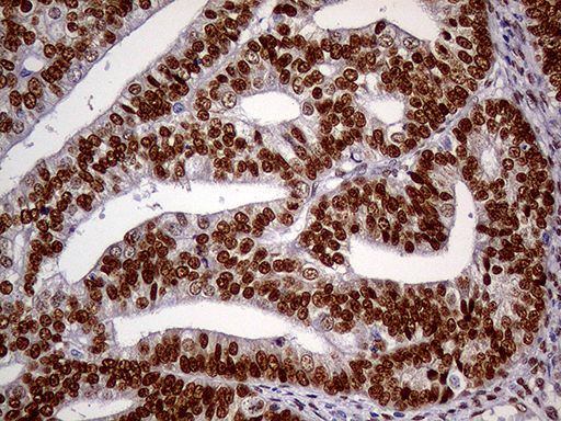 MEIS1 Antibody - Immunohistochemical staining of paraffin-embedded Adenocarcinoma of Human endometrium tissue using anti-MEIS1 mouse monoclonal antibody. (Heat-induced epitope retrieval by 1mM EDTA in 10mM Tris buffer. (pH8.5) at 120°C for 3 min. (1:500)