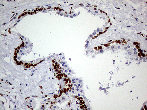 MEIS1 Antibody - Immunohistochemical staining of paraffin-embedded Carcinoma of Human prostate tissue using anti-MEIS1 mouse monoclonal antibody. (Heat-induced epitope retrieval by 1mM EDTA in 10mM Tris buffer. (pH8.5) at 120°C for 3 min. (1:500)