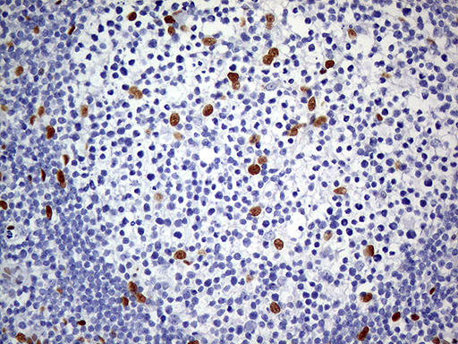 MEIS1 Antibody - Immunohistochemical staining of paraffin-embedded Human lymph node tissue within the normal limits using anti-MEIS1 mouse monoclonal antibody. (Heat-induced epitope retrieval by 1mM EDTA in 10mM Tris buffer. (pH8.5) at 120°C for 3 min. (1:500)