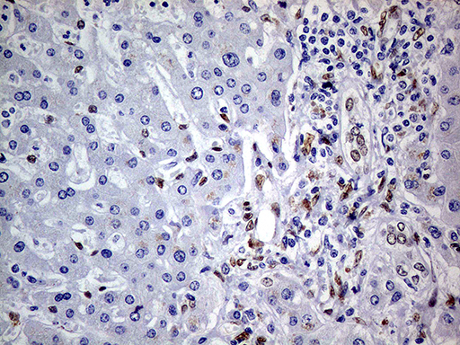 MEIS1 Antibody - Immunohistochemical staining of paraffin-embedded Carcinoma of Human liver tissue using anti-MEIS1 mouse monoclonal antibody. (Heat-induced epitope retrieval by 1mM EDTA in 10mM Tris buffer. (pH8.5) at 120°C for 3 min. (1:500)
