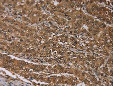 MEIS1 Antibody - Immunohistochemistry of paraffin-embedded Human thyroid cancer using MEIS1 Polyclonal Antibody at dilution of 1:30.
