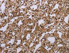 MEIS1 Antibody - Immunohistochemistry of paraffin-embedded Human esophagus cancer using MEIS1 Polyclonal Antibody at dilution of 1:40.