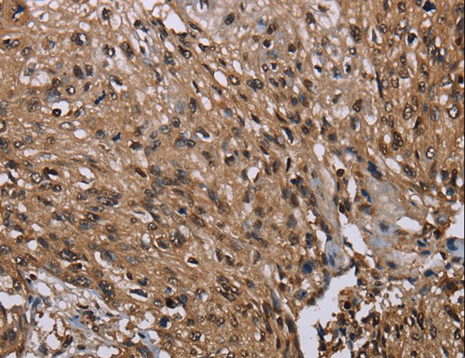 MEIS1 Antibody - Immunohistochemistry of paraffin-embedded Human esophagus cancer using MEIS1 Polyclonal Antibody at dilution of 1:40.