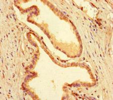 MEIS1 Antibody - Immunohistochemistry of paraffin-embedded human prostate cancer at dilution of 1:100