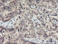 MEIS3 Antibody - IHC of paraffin-embedded Adenocarcinoma of Human ovary tissue using anti-MEIS3 mouse monoclonal antibody. (Heat-induced epitope retrieval by 10mM citric buffer, pH6.0, 100C for 10min).