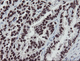 MEIS3 Antibody - IHC of paraffin-embedded Adenocarcinoma of Human ovary tissue using anti-MEIS3 mouse monoclonal antibody.