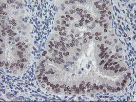 MEIS3 Antibody - IHC of paraffin-embedded Adenocarcinoma of Human endometrium tissue using anti-MEIS3 mouse monoclonal antibody.