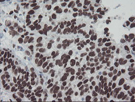 MEIS3 Antibody - IHC of paraffin-embedded Adenocarcinoma of Human ovary tissue using anti-MEIS3 mouse monoclonal antibody.