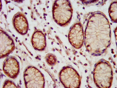 MEIS3 Antibody - Immunohistochemistry image at a dilution of 1:200 and staining in paraffin-embedded human gastric cancer performed on a Leica BondTM system. After dewaxing and hydration, antigen retrieval was mediated by high pressure in a citrate buffer (pH 6.0) . Section was blocked with 10% normal goat serum 30min at RT. Then primary antibody (1% BSA) was incubated at 4 °C overnight. The primary is detected by a biotinylated secondary antibody and visualized using an HRP conjugated SP system.