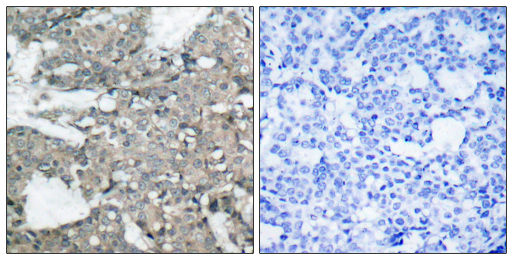 MEK1 + MEK2 Antibody - Immunohistochemistry analysis of paraffin-embedded human breast carcinoma tissue, using MEK1/2 Antibody. The picture on the right is blocked with the synthesized peptide.