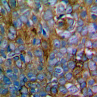 MEK1 + MEK2 Antibody - Immunohistochemical analysis of MKK1/2 staining in human prostate cancer formalin fixed paraffin embedded tissue section. The section was pre-treated using heat mediated antigen retrieval with sodium citrate buffer (pH 6.0). The section was then incubated with the antibody at room temperature and detected using an HRP conjugated compact polymer system. DAB was used as the chromogen. The section was then counterstained with hematoxylin and mounted with DPX.