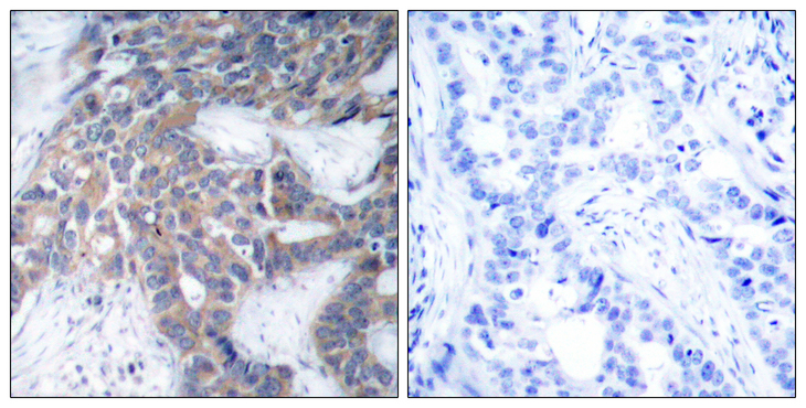 MEK1 + MEK2 Antibody - Immunohistochemistry analysis of paraffin-embedded human breast carcinoma, using MEK1/2 (Phospho-Ser217) Antibody. The picture on the right is blocked with the phospho peptide.