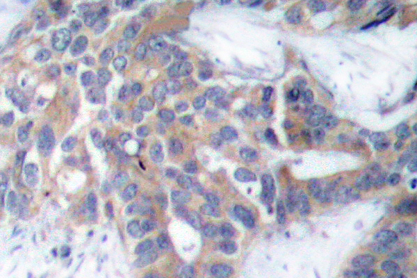MEK1 + MEK2 Antibody - IHC of p-MEK-1/2 (S218/222) pAb in paraffin-embedded human breast carcinoma tissue.