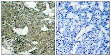 MEK1 + MEK2 Antibody - Immunohistochemistry analysis of paraffin-embedded human breast carcinoma, using MEK1/2 (Phospho-Ser221) Antibody. The picture on the right is blocked with the phospho peptide.