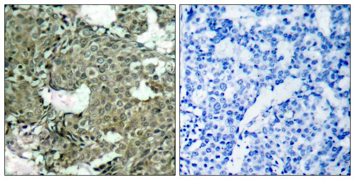 MEK1 + MEK2 Antibody - P-Peptide - + Immunohistochemical analysis of paraffin-embedded breast carcinoma tissue using MEK1 (phospho- Ser221) antibody.