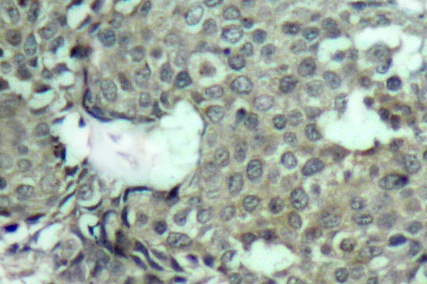 MEK1 + MEK2 Antibody - IHC of p-MEK-1/2 (S222/226) pAb in paraffin-embedded human breast carcinoma tissue.
