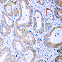 MEK1 + MEK2 Antibody - Immunohistochemical analysis of MKK1/2 (pS222/226) staining in human colon cancer formalin fixed paraffin embedded tissue section. The section was pre-treated using heat mediated antigen retrieval with sodium citrate buffer (pH 6.0). The section was then incubated with the antibody at room temperature and detected using an HRP conjugated compact polymer system. DAB was used as the chromogen. The section was then counterstained with hematoxylin and mounted with DPX.