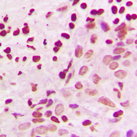 MEK3/6 Antibody - Immunohistochemical analysis of MKK3/6 staining in human breast cancer formalin fixed paraffin embedded tissue section. The section was pre-treated using heat mediated antigen retrieval with sodium citrate buffer (pH 6.0). The section was then incubated with the antibody at room temperature and detected using an HRP conjugated compact polymer system. DAB was used as the chromogen. The section was then counterstained with hematoxylin and mounted with DPX.