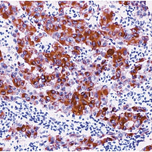 Melanoma Antibody - Formalin-fixed, paraffin-embedded human melanoma stained with Melanoma antibody.