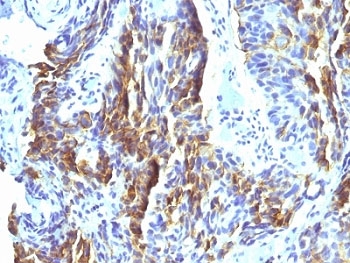 Melanoma Antibody - Formalin-fixed, paraffin-embedded human tongue stained with Melanoma Associated Antigen antibody (KBA.62).  This image was taken for the unmodified form of this product. Other forms have not been tested.
