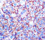 Melanoma Antibody - IHC of Melanoma/KBA.62 on FFPE Melanoma tissue. This image was taken for the unmodified form of this product. Other forms have not been tested.