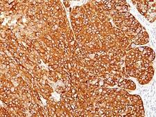 Melanoma Antibody - Formalin-fixed, paraffin-embedded human melanoma stained with melanoma Marker antibody (M2-7C10 + M2-9E3 + T311 + HMB45).  This image was taken for the unmodified form of this product. Other forms have not been tested.