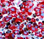 Melanoma Antibody - IHC of Melanoma/PNL2 on FFPE Melanoma tissue.