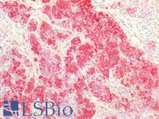 Melanoma Antibody - Human Skin, Melanoma: Formalin-Fixed, Paraffin-Embedded (FFPE)