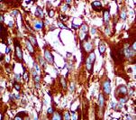 Melanoma Antibody - IHC of Melanoma Cocktail on FFPE Melanoma tissue. This image was taken for the unmodified form of this product. Other forms have not been tested.