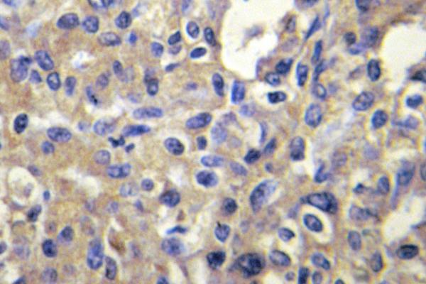 MELK Antibody - IHC of MELK (N449) pAb in paraffin-embedded human liver carcinoma tissue.