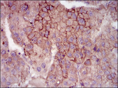 MELK Antibody - IHC of paraffin-embedded liver cancer tissues using MELK mouse monoclonal antibody with DAB staining.