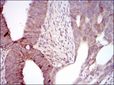 MELK Antibody - IHC of paraffin-embedded rectum cancer tissues using MELK mouse monoclonal antibody with DAB staining.