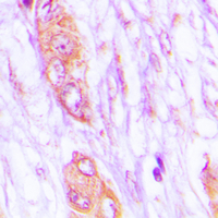 MELK Antibody - Immunohistochemical analysis of MELK staining in human lung cancer formalin fixed paraffin embedded tissue section. The section was pre-treated using heat mediated antigen retrieval with sodium citrate buffer (pH 6.0). The section was then incubated with the antibody at room temperature and detected using an HRP conjugated compact polymer system. DAB was used as the chromogen. The section was then counterstained with hematoxylin and mounted with DPX.