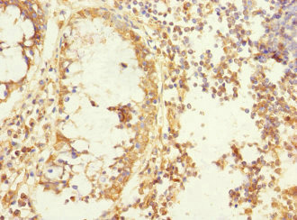 MEMO1 Antibody - Immunohistochemistry of paraffin-embedded human colon cancer at dilution 1:100
