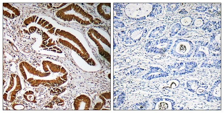 MEN1 / Menin Antibody - Peptide - + Immunohistochemistry analysis of paraffin-embedded human colon carcinoma tissue, using MEN1 antibody.