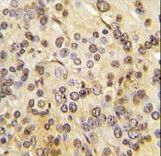 MEN1 / Menin Antibody - Formalin-fixed and paraffin-embedded human prostate carcinoma tissue reacted with MEN1 Antibody (T594) , which was peroxidase-conjugated to the secondary antibody, followed by DAB staining. This data demonstrates the use of this antibody for immunohistochemistry; clinical relevance has not been evaluated.