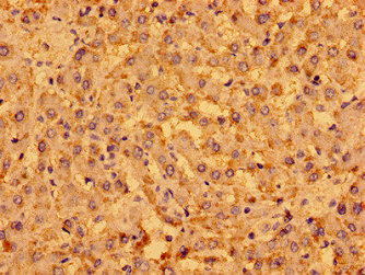 MENT / C1orf56 Antibody - Immunohistochemistry image of paraffin-embedded human liver cancer at a dilution of 1:100