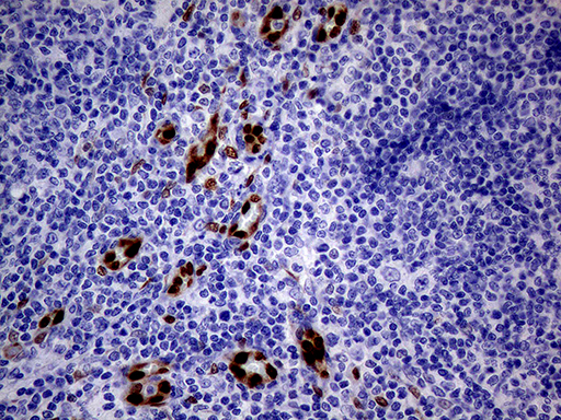 MEOX1 Antibody - Immunohistochemical staining of paraffin-embedded Human lymphoma tissue using anti-MEOX1 mouse monoclonal antibody. (Heat-induced epitope retrieval by 1mM EDTA in 10mM Tris buffer. (pH8.5) at 120°C for 3 min. (1:500)