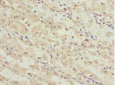 MEOX1 Antibody - Immunohistochemistry of paraffin-embedded human gastric cancer at dilution 1:100