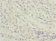 MEOX1 Antibody - Immunohistochemistry of paraffin-embedded human gastric cancer at dilution 1:100