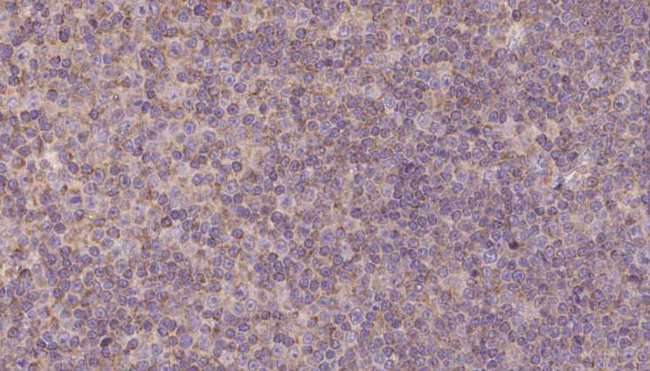 MEPCE Antibody - 1:100 staining human lymph carcinoma tissue by IHC-P. The sample was formaldehyde fixed and a heat mediated antigen retrieval step in citrate buffer was performed. The sample was then blocked and incubated with the antibody for 1.5 hours at 22°C. An HRP conjugated goat anti-rabbit antibody was used as the secondary.