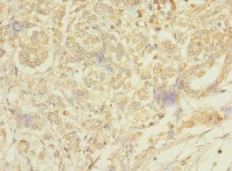 MESP1 Antibody - Immunohistochemistry of paraffin-embedded human pancreatic cancer at dilution 1:100